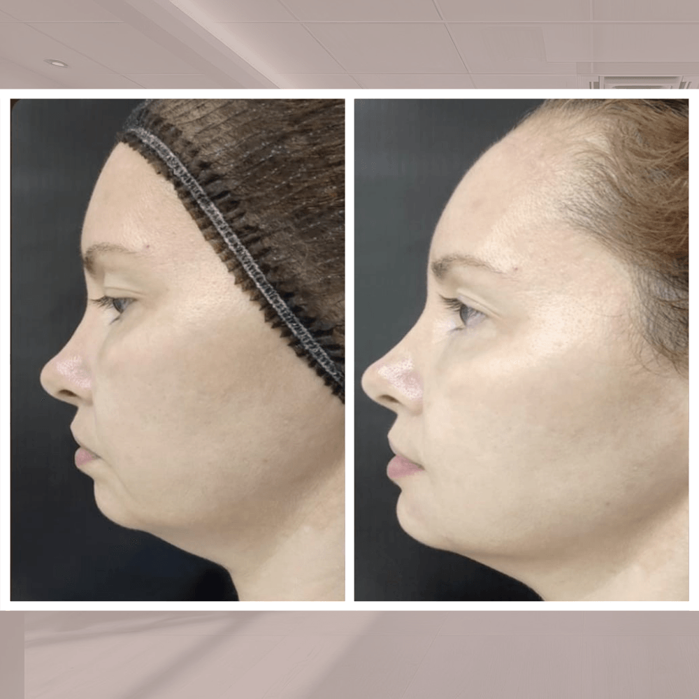 Preenchimento de mento (Queixo)