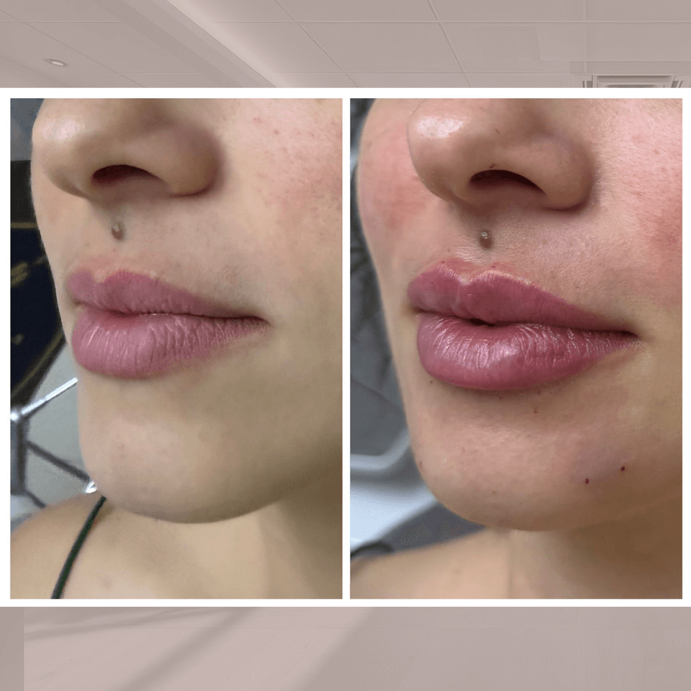 Preenchimento Labial