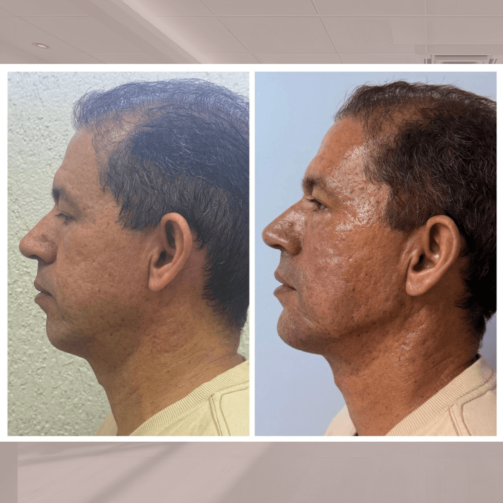 Preenchimento de mandíbula