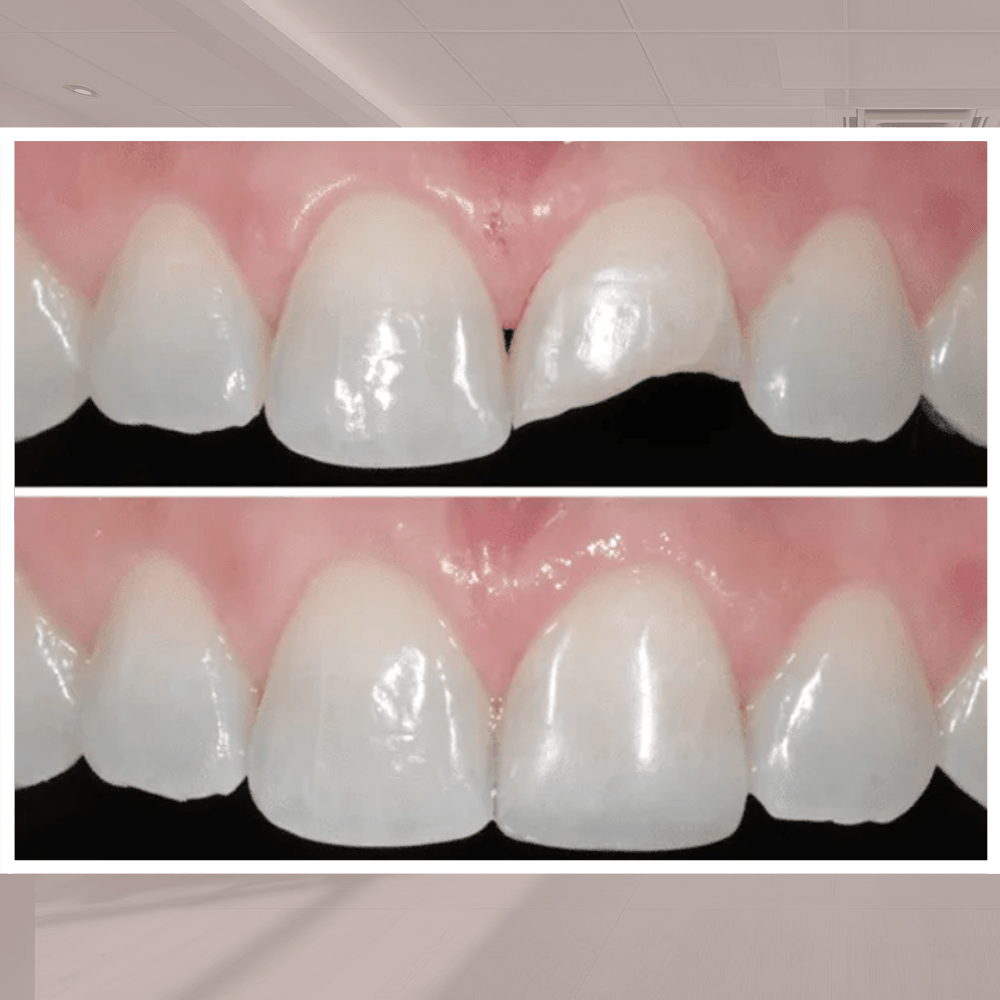 Restauração em Resina